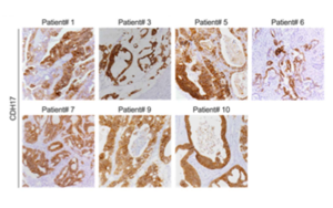 靶向钙黏蛋白17(Cadherin-17/CDH17)的CAR-T细胞系统性递送策略:安全有效治疗结直肠癌肝转移的新突破 靶向钙黏蛋白17(Cadherin-17/CDH17)的CAR-T细胞系统性递送策略:安全有效治疗结直肠癌肝转移的新突破