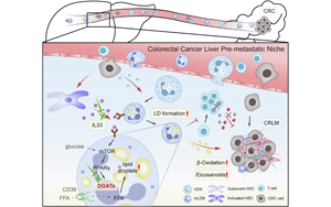 IL33诱导成熟低密度中性粒细胞脂滴形成驱动结直肠癌肝转移的机制与治疗新策略