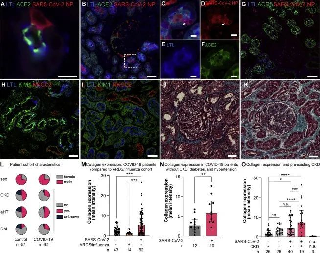 新冠病毒存在于感染者的肾细胞中并诱导肾脏纤维化