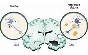 Cell Stem Cell：退化的神经元是阿尔茨海默病患者大脑炎症的来源
