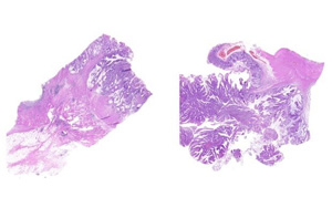 研究揭示了同时发生APC和MLH1种系突变的结直肠肿瘤的体细胞突变谱